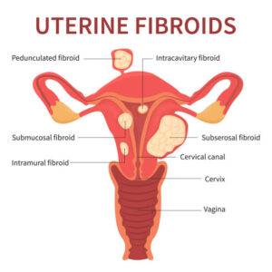 Uterine Fibroids medical illustration
