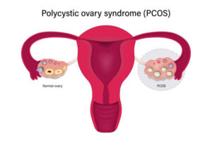 Polycystic ovary syndrome PCOS. Multiple immature follicles vector. Ovarian cysts with female reproductive system.